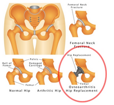 Hip Replacement