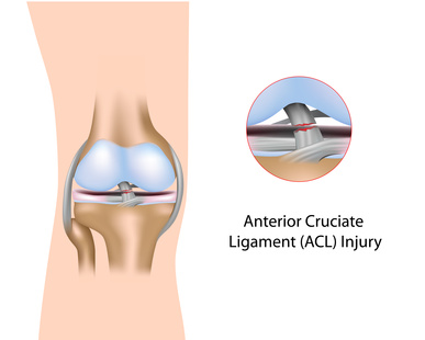 acl_tear acl_tear