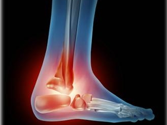 ankle_swelling