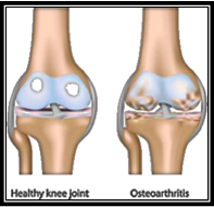 arthritic_knee_01