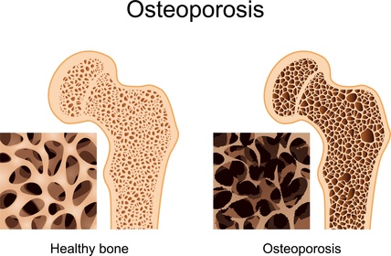 osteoporosis_fracture