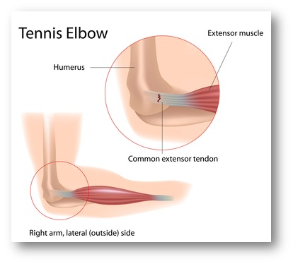 Tennis Elbow: What is it? Fast and Easy Solutions, Do not delay doing this
